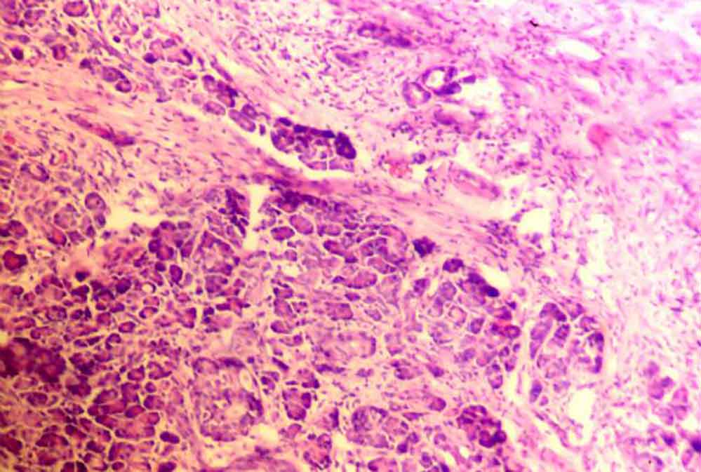 pankreatitis-trebušna-slinavka